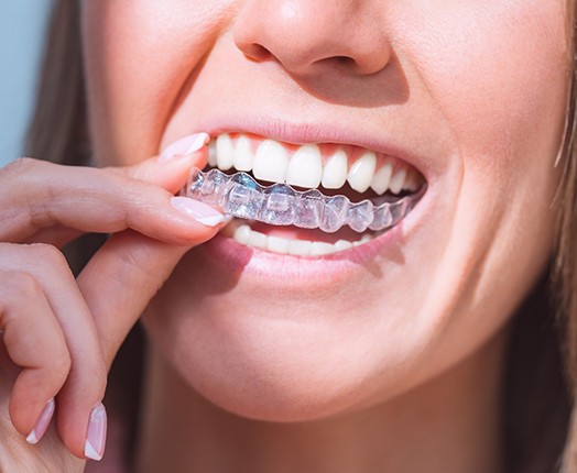 A woman placing Invisalign clear aligners on her teeth 