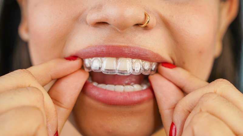 A woman holding Invisalign aligners over her teeth